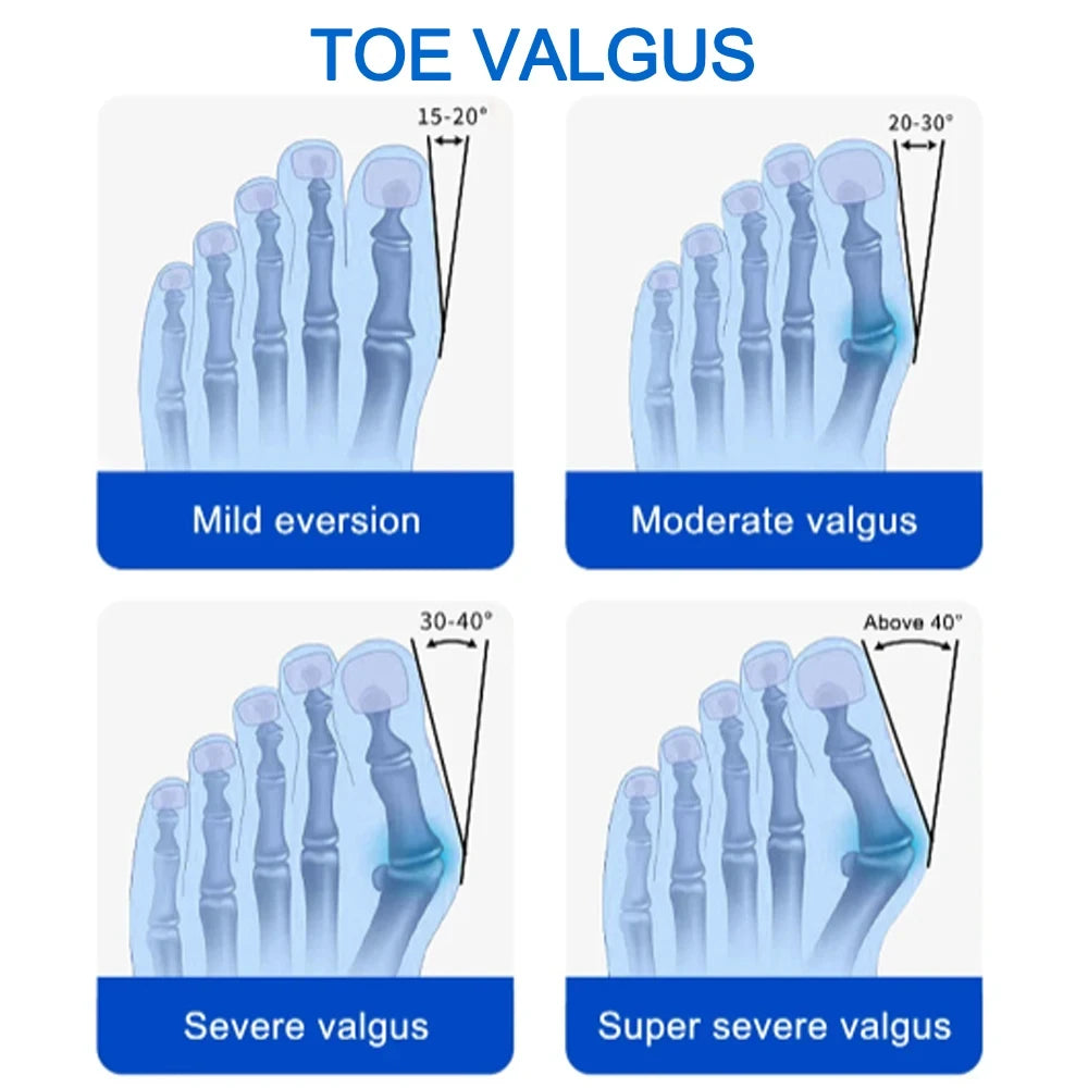 Nighttime Bunion Alignment Splint